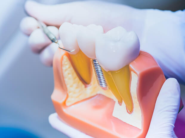 IMPLANT 失った歯を取り戻すインプラント治療