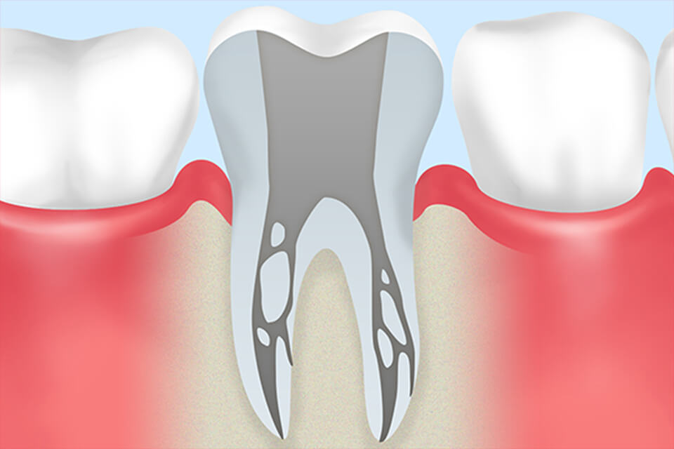 残せる歯をしっかり残す根管治療